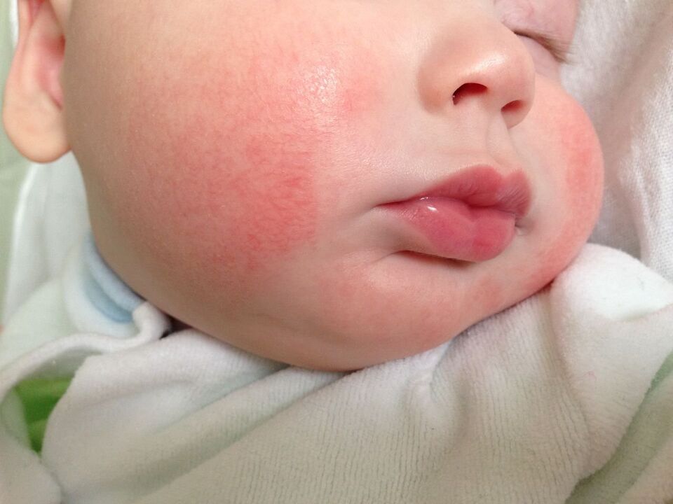 Znak glista u djeteta je alergijska urtikarija